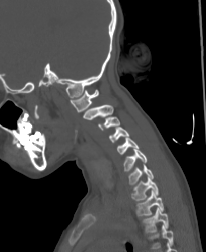 File:Butterfly vertebra (Radiopaedia 77903-90209 Sagittal bone window 76).jpg