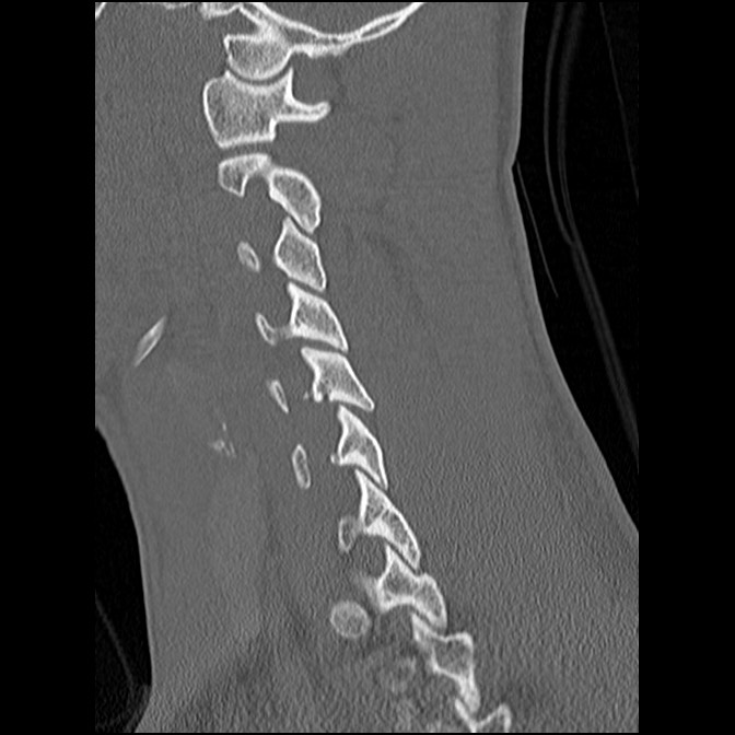 C5 facet fracture (Radiopaedia 58374-65499 Sagittal bone window 28).jpg