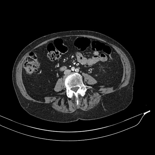 Calcified adrenal glands and Spigelian hernia (Radiopaedia 49741-54988 A 126).jpg