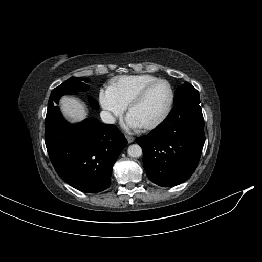 Calcified adrenal glands and Spigelian hernia (Radiopaedia 49741-54988 A 8).jpg
