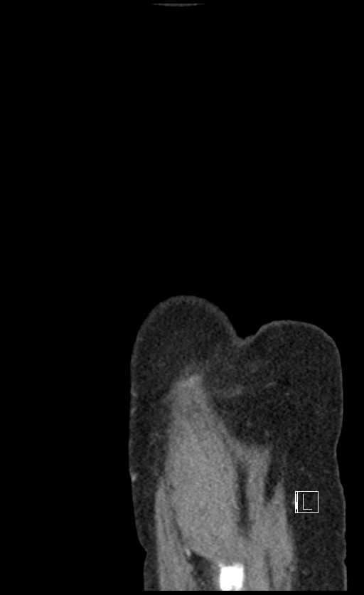 Calcified adrenal glands and Spigelian hernia (Radiopaedia 49741-54988 C 1).jpg