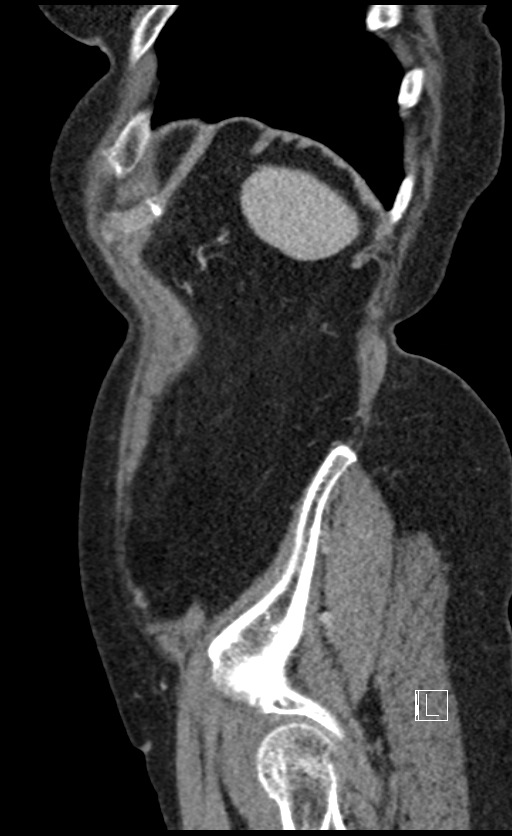 Calcified adrenal glands and Spigelian hernia (Radiopaedia 49741-54988 C 23).jpg
