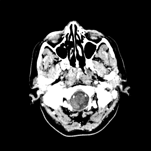 Calcified cerebral hydatid cyst (Radiopaedia 65603-74717 Axial with contrast 1).jpg