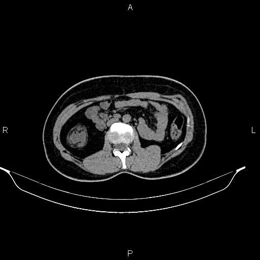 File:Calcified hepatic hydatid cyst (Radiopaedia 84672-100095 Axial non-contrast 51).jpg