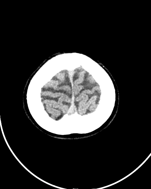 Calcified meningioma (Radiopaedia 74361-85243 Axial non-contrast 5).jpg