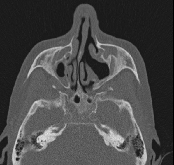 Caldwell-Luc operation (Radiopaedia 52329-58225 Axial bone window 31).jpg