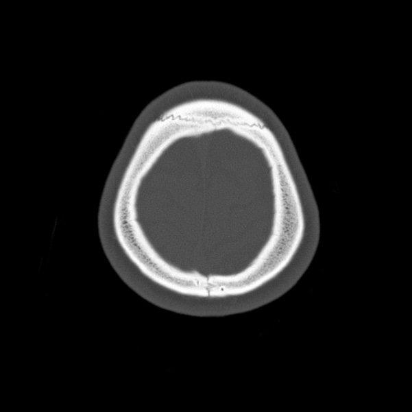 Calvarial osteoma (Radiopaedia 36520-38079 Axial bone window 98).jpg