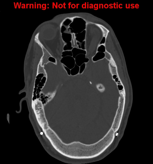 Calvarial thickening from chronic shunting (Radiopaedia 60079-67637 Axial bone window 61).jpg