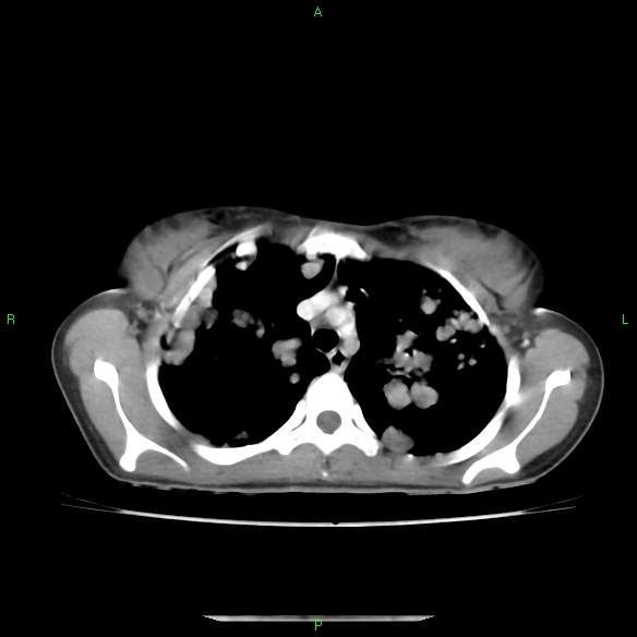 File:Cannon ball metastases - synovial sarcoma (Radiopaedia 26135-26271 C 10).jpg