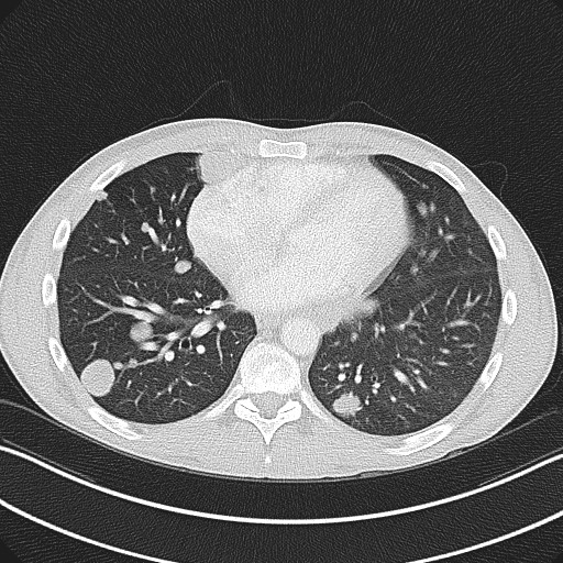 Cannonball metastases - testicular choriocarcinoma (Radiopaedia 84510-99891 Axial lung window 64).jpg