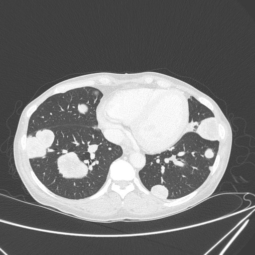 Canonball lung metastasis (Radiopaedia 77634-89837 Axial lung window 128).jpg