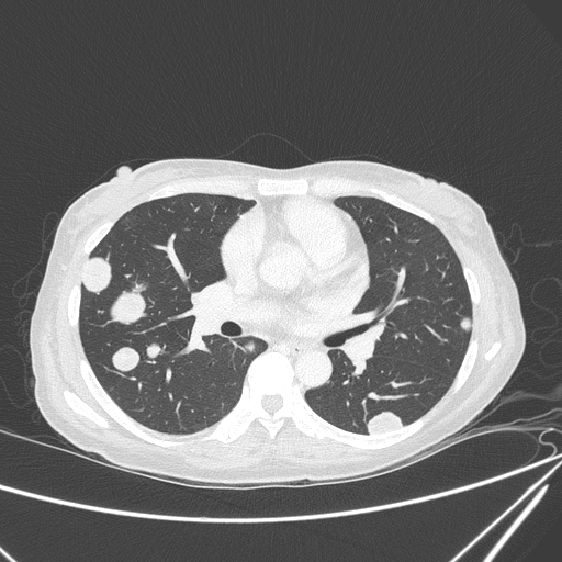 File:Canonball lung metastasis (Radiopaedia 77634-89837 Axial lung window 88).jpg