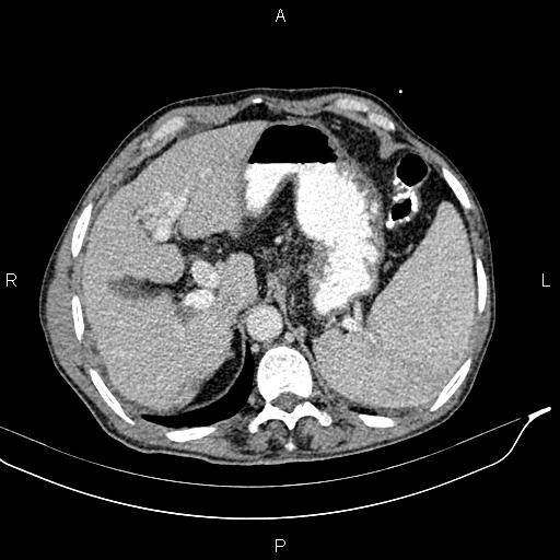 File:Caput medusae sign - portal hypertension (Radiopaedia 64007-72759 A 15).jpg