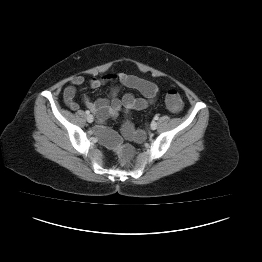 Carcinoma colon - hepatic flexure (Radiopaedia 19461-19493 A 104).jpg