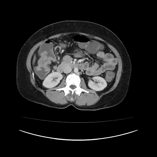 Carcinoma colon - hepatic flexure (Radiopaedia 19461-19493 A 56).jpg