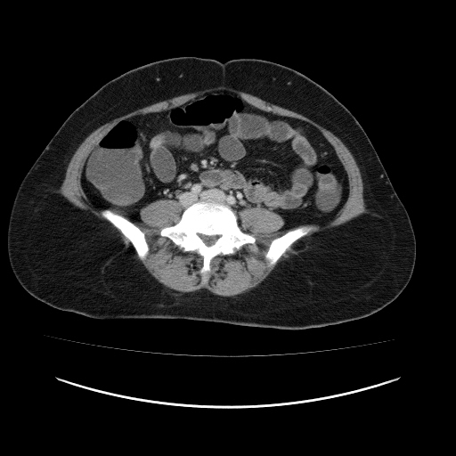 File:Carcinoma colon - hepatic flexure (Radiopaedia 19461-19493 A 82).jpg