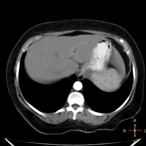 File:Carcinoma of sigmoid colon (Radiopaedia 23071-23100 C+ arterial phase 3).jpg