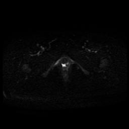 Carcinoma of the cervix (Radiopaedia 89018-105858 Axial DWI 5).jpg