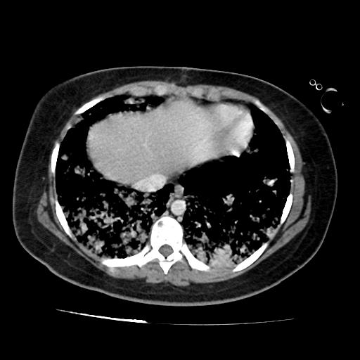 File:Cardiac angiosarcoma (Radiopaedia 66010-75181 B 78).jpg