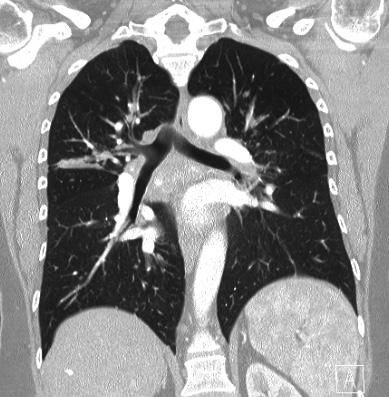 Cardiac sarcoidosis (Radiopaedia 74548-85534 Coronal lung window 41).jpg