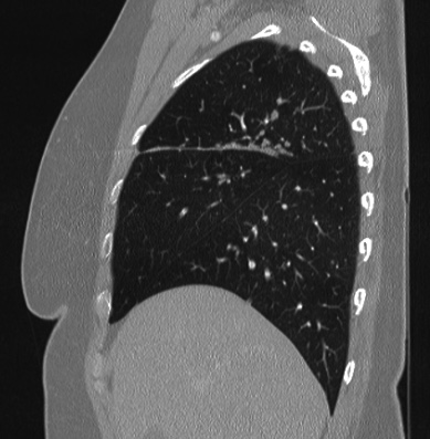 Cardiac sarcoidosis (Radiopaedia 74548-85534 Sagittal lung window 72).jpg