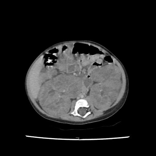 Caroli disease with autosomal recessive polycystic kidney disease (ARPKD) (Radiopaedia 89651-106703 B 125).jpg