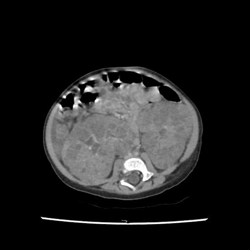 Caroli disease with autosomal recessive polycystic kidney disease (ARPKD) (Radiopaedia 89651-106703 B 136).jpg