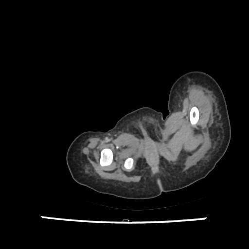 File:Caroli disease with autosomal recessive polycystic kidney disease (ARPKD) (Radiopaedia 89651-106703 B 245).jpg
