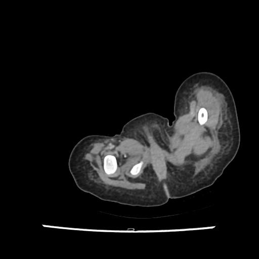 Caroli disease with autosomal recessive polycystic kidney disease (ARPKD) (Radiopaedia 89651-106703 B 248).jpg