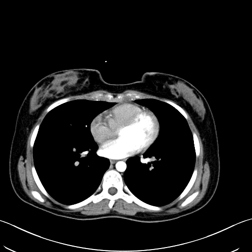 Caroli disease with medullary sponge kidney (Radiopaedia 82622-96804 C 2).jpg