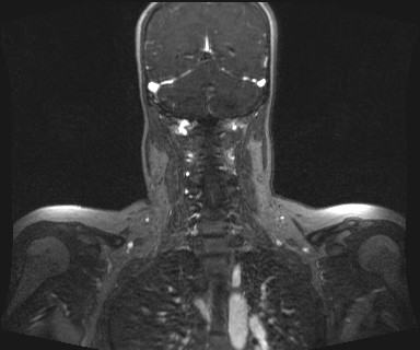 Carotid body tumor (Radiopaedia 12777-12912 MRA 54).jpg