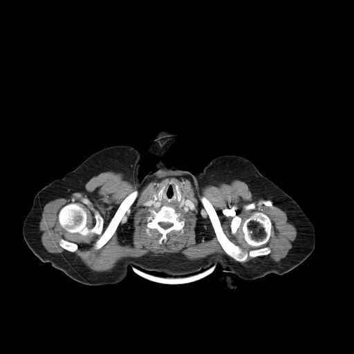 File:Carotid body tumor (Radiopaedia 21021-20948 B 19).jpg