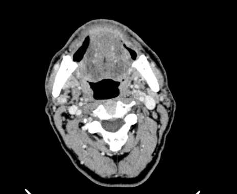 Carotid body tumor (Radiopaedia 61750-69757 Axial Post contrast 34).jpg