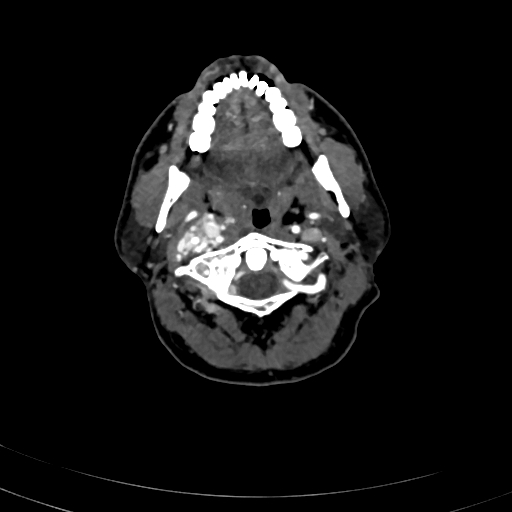 Carotid body tumor (Radiopaedia 83615-98727 A 38).jpg