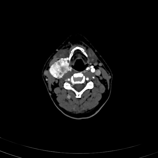 Carotid body tumor (Radiopaedia 83615-98727 A 61).jpg