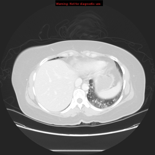 Carotid body tumor with lung metastases (Radiopaedia 9301-48390 Axial lung window 56).jpg