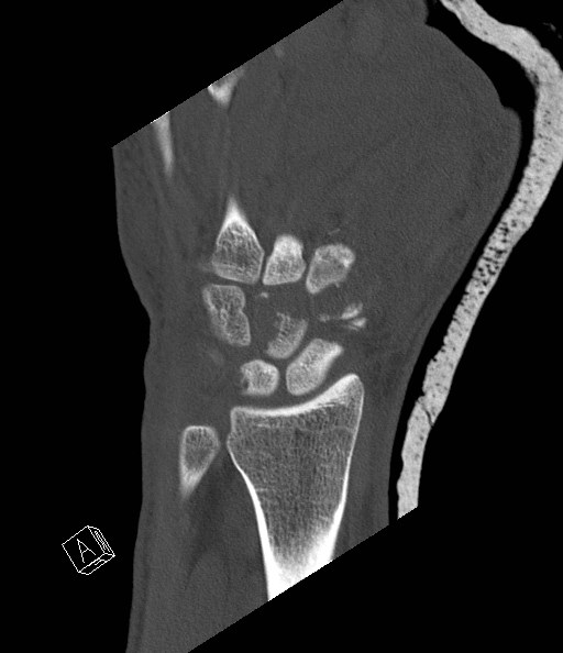 File:Carpal fractures (smart watch impaction) (Radiopaedia 55844-62430 Coronal bone window 9).jpg