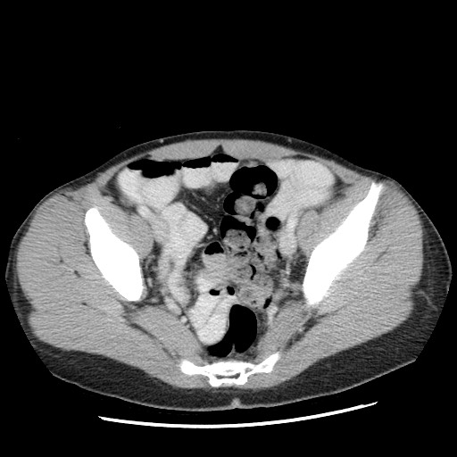 File:Castleman disease with fibrous pseudotumor in the abdomen (Radiopaedia 77296-89373 A 105).jpg