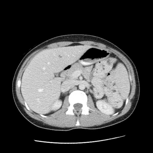 File:Castleman disease with fibrous pseudotumor in the abdomen (Radiopaedia 77296-89373 Axial 67).jpg