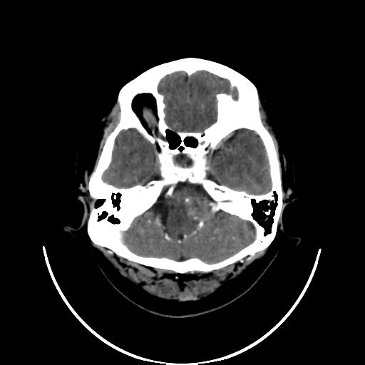 File:Cavernoma with developmental venous anomaly (Radiopaedia 22470-22506 C+ arterial phase 7).jpg