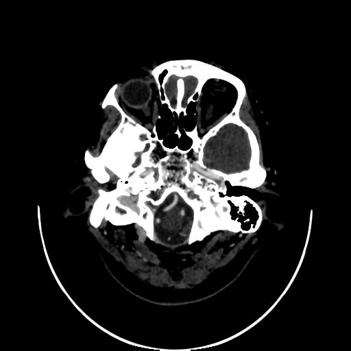 Cavernoma with developmental venous anomaly (Radiopaedia 22470-22506 C 10).jpg