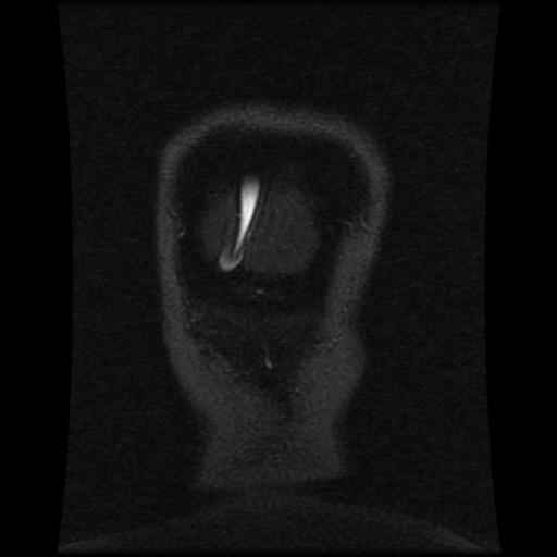 Cavernoma with developmental venous anomaly (Radiopaedia 22470-22507 MRV 25).jpg