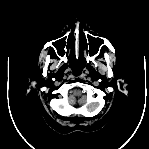 Cavernous hemangioma of the cerebellar falx (Radiopaedia 73025-83723 Axial non-contrast 9).jpg