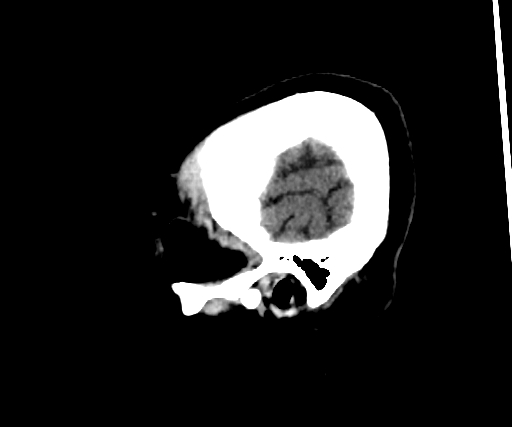 Cavernous hemangioma of the cerebellar falx (Radiopaedia 73025-83723 B 297).jpg