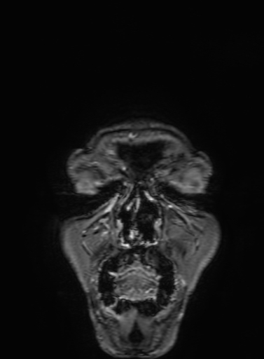 Cavernous hemangioma of the cerebellar falx (Radiopaedia 73025-83724 Coronal T1 C+ 7).jpg