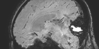 Cavernous hemangioma of the cerebellar falx (Radiopaedia 73025-83724 Sagittal BOLD 109).jpg