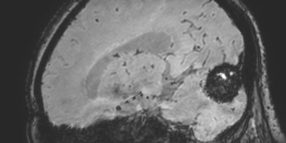 Cavernous hemangioma of the cerebellar falx (Radiopaedia 73025-83724 Sagittal BOLD 124).jpg