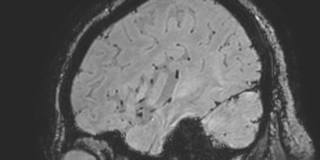 Cavernous hemangioma of the cerebellar falx (Radiopaedia 73025-83724 Sagittal BOLD 41).jpg