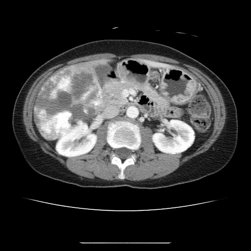 Cavernous hepatic hemangioma (Radiopaedia 75441-86667 B 48).jpg
