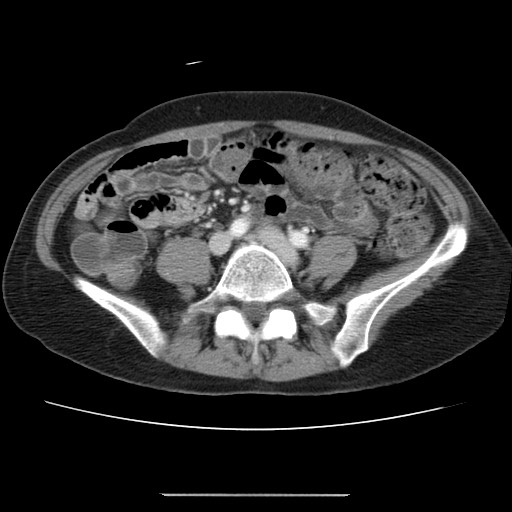 File:Cavernous hepatic hemangioma (Radiopaedia 75441-86667 B 77).jpg